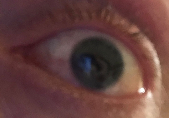 Image shows a close up view of my eye, which has no visible iris around the pupil