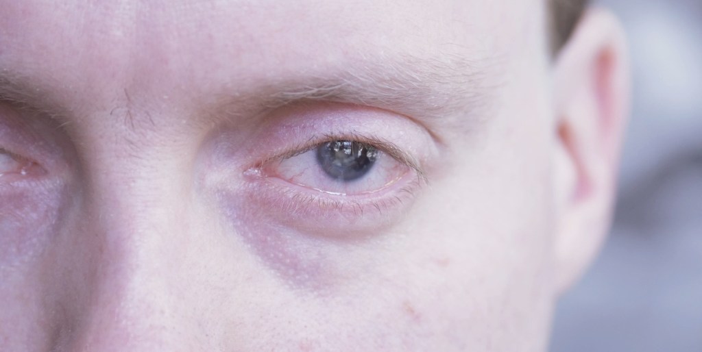 Close-up of Glen's eye, which doesn't have an iris, the coloured circle, around the pupil. The students filming Glen can be seen in the reflection in his pupil.